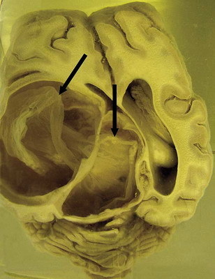 paraziti v lidskem mozku lungimea viermei